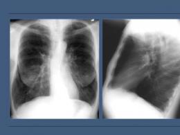 Рентген легких: при курении, нарушении бронхиальной проходимости